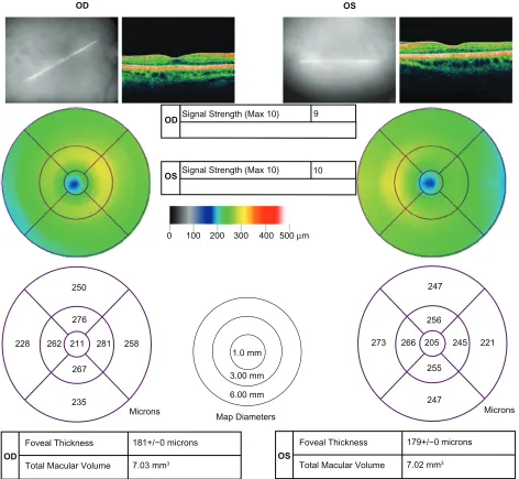 Figure 4 Optical computed topography (OCT) scans of both eyes indicate resolutions of macular thinning OU two months after beginning treatment.