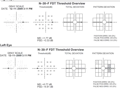 Figure 5 Frequency Doubling Technology (FDT) Visual Field Tests showed normal VF OD and a few areas of loss OS two months after beginning treatment.