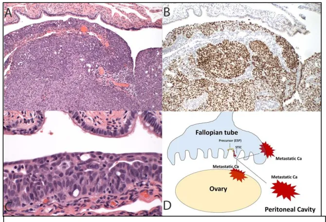 Figure 1. In this more conventional model of high-grade serous cancer development, the tumor initiates in the fallopian tube (A) and contains a TP53 mutation highlighted in this case by diffuse immunostaining for p53 (B) as well as a recognizable serous tu