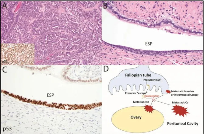 Figure 2. In this second and complementary model of serous tubal carcinogenesis, an advanced malignancy with a TP53 mutation will be discovered (A) yet the only abnormality in the fallopian tube will be an early serous proliferation (ESP)(B) with strong p5