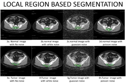 Figure 7: CT Tumor detection using Level Sets based Segmentationan International Journal, AIRCCSE Publishers, SIPIJ, June 