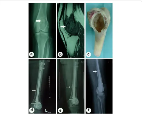 Fig. 2 Case presentation I. Case 43: A 19-year-old man was diagnosed as having osteosarcoma in the distal of his left femur and was treatedwith wide resection and inactivated autograft using alcohol