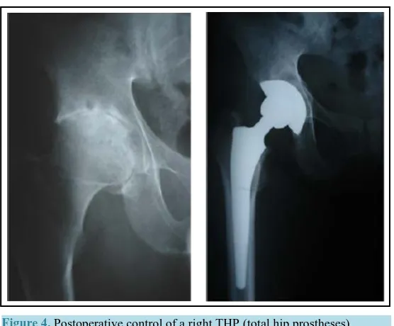 Figure 4. Postoperative control of a right THP (total hip prostheses).       