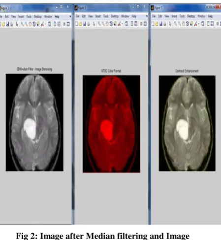 Fig 2: Image after Median filtering and Image enhancement 