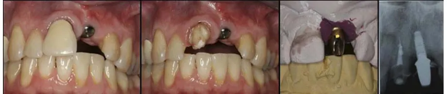 Figure 1 Non-restorable tooth #11 due to ongoing external root resorption.