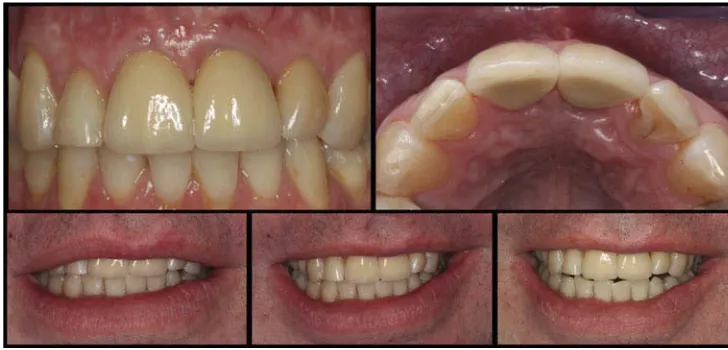 Figure 10 Final crowns cemented with temporary cement.