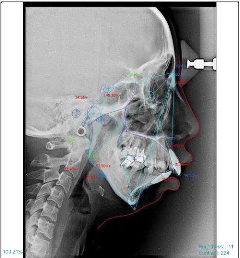 Figure 2 Class II skeletal malocclusion with great value of anB, go2, and Yaxis-sn.