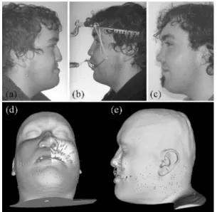 Fig. 5. Illustration of craniofacial intervention: Lengthening the maxilla by distraction osteogenesis