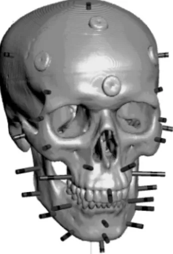 Fig. 10. Dowels representing the soft tissue thickness at standardized locations on the cranial bone.