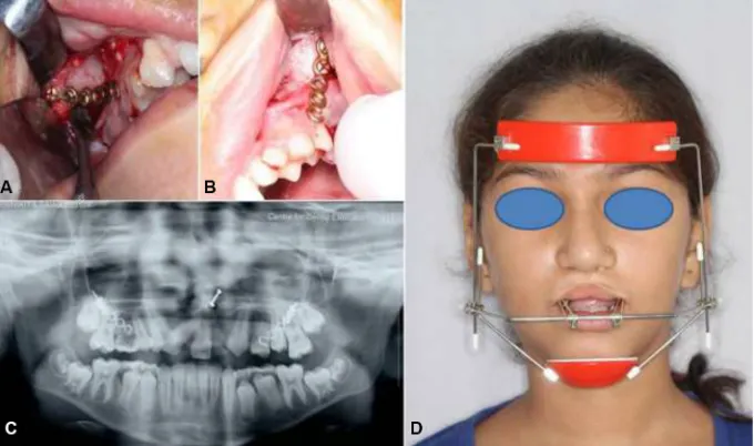 Figure 5 Bone-anchored maxillary protraction: attached to miniplates through Class III elastics for maxillary protraction.Abbreviation:(A) placement of miniplate in infrazygomatic crest; (B) miniplate in situ; (C) OPG showing miniplates; and (D) facemask  OPG, orthopantomogram.