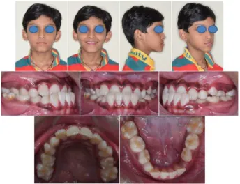 Figure 7 Pretreatment digital study models showing Class III malocclusion.