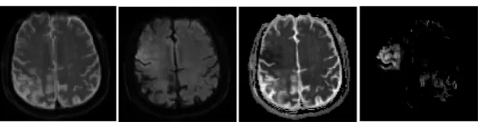 Figure 2. From left to right, axial slices of B0, DWI, ADC and ASM. 