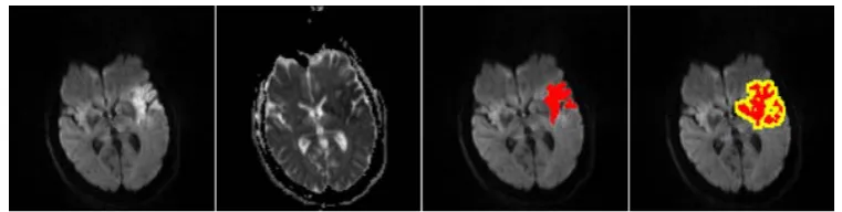 Figure 3. From left to right, an axial slice of DWI, ADC, the segmented ischemic regions form [5] on DWI and the corresponding ROIs for detecting infarction overlaid in color on DWI, where the region in red are initial ROIs from [5] while those in yellow a