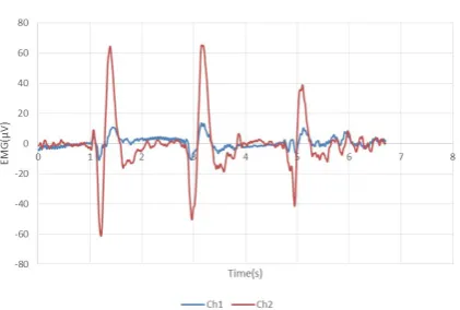 Figure 5. Masseter EMG signal. 