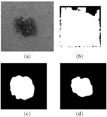 Fig. 4. Comparison between the membership functions results. ( a ) original image; ( b ) lesion detection with the function = 1; ( c ) lesion detection with the function = 2;