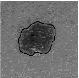 Fig. 7. Detection of the lesion boundary of the lesion in Figure 4. ( a ) .