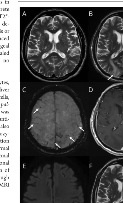Figure 1 Brain MRI slices before admission, upon admis-