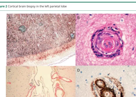Figure 2 Cortical brain biopsy in the left parietal lobe