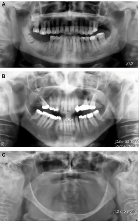 Figure 1 The three panoramic radiographs show the large variation in bone mass, trabeculation, and basal cortex in persons 79- or 80-years-old
