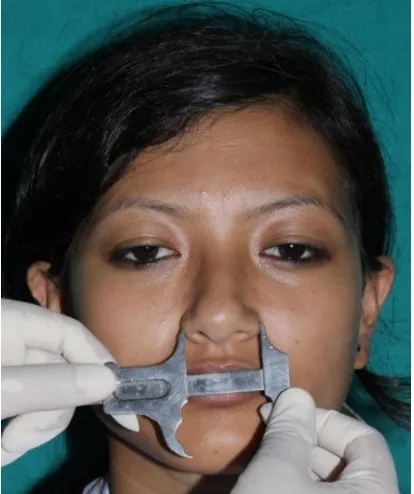 Figure 1 Measurement of mesiodistal width of central incisor.