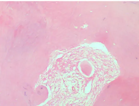 Figure 4 Mural proliferation of odontogenic epithelial islands.