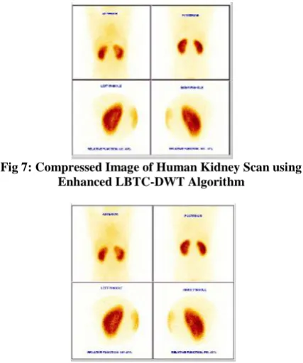 Fig 7: Compressed Image of Human Kidney Scan using  Enhanced LBTC-DWT Algorithm 