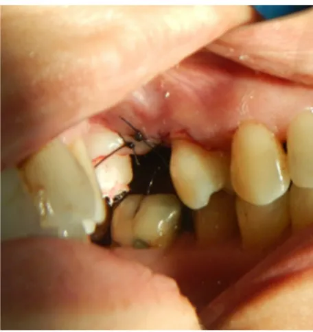 Figure 5 occlusal view of the temporary abutment and crown issued on the day of surgery (implant placement); small occlusal table with no adjacent tooth contact