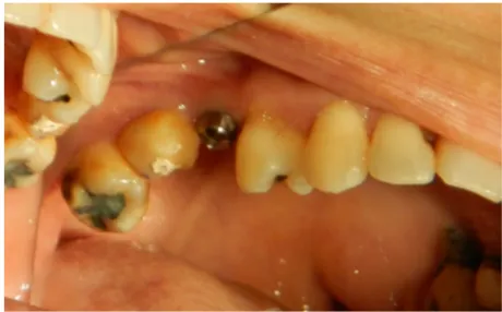 Figure 7 Second stage of temporary crown modification 1 month after implant placement