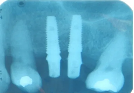 Figure 10 Differences are seen in the gingival contour around temporary crown 26 and healing abutment in the 25-position implant