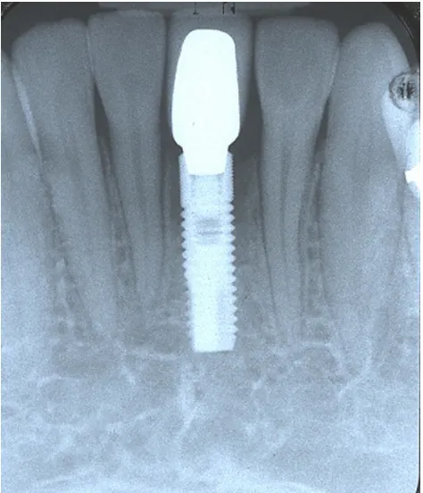 Figure 1A Preoperative view showing malpositioned implant.