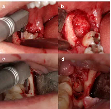 Figure 3 a) Harvesting of a block graft from the left ramus region. Intraoperative (10 days) was without complications
