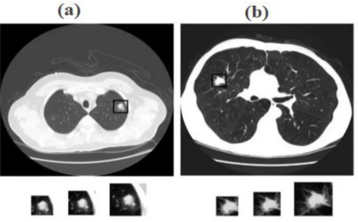 Fig 1.  Example of (a) Benign nodule and (b), Malignant nodule. 