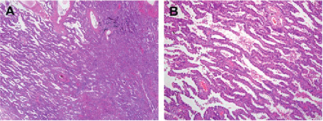 Figure 4: adenocarcinoma ( A: Lepidic predominant pattern with mostly lepidic growth and B: invasive  acinar adenocarcinoma)  29 .