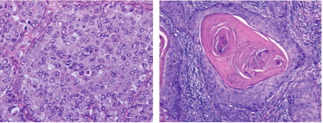 Figure 5: squamous cell carcinoma  29  and large cell carcinoma  29 . Large cell carcinoma 