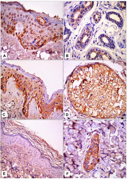 Figure 1 JAK1 immunohistochemical staining.lesional vitiligo skin sections. 200× (cytoplasmic JAK1 expression with focal nucleocytoplasmic localization in perilesional vitiligo skin sections; (skin; (Notes: (A) Nucleocytoplasmic JAK1 expression in epidermis in control skin; (B) cytoplasmic expression of JAK1 in eccrine and sweat-gland ducts in control skin; (C) EpidermalD) cytoplasmic JAK1 expression in pilosebaceous unit in perilesionalE) nucleocytoplasmic JAK1 expression in epidermis in lesional skin sections; (F) cytoplasmic JAK1 expression in eccrine and sweat-gland ducts and dermal ﬁbroblasts inA–C); 100× for (E); 400× (D,F).