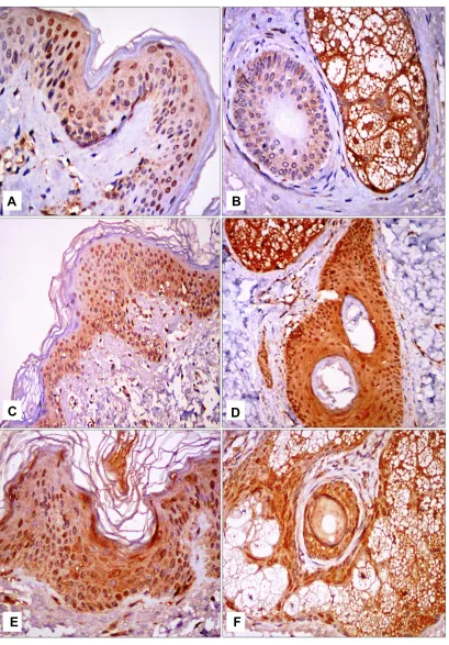 Figure 2 STAT3 immunohistochemical staining.vitiligo skin showed epidermal nucleocytoplasmic STAT3 expression; (Notes: (A) Epidermal nucleocytoplasmic STAT3 expression in control skin; (B) nucleocytoplasmic STAT3 expression in pilosebaceous unit in control