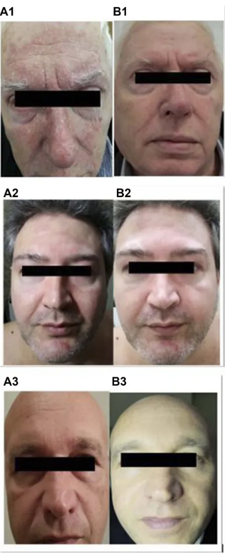 Figure 4 Color pictures of three subjects (1, 2 and 3) at baseline (weeks of treatment with EDS (A) and after 6B).