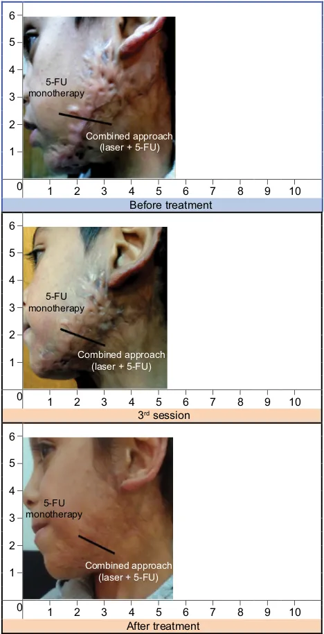 Figure 4 Comparison photos: the upper part was treated with 5-FU monotherapy and the lower part was treated with the combined approachNote: The combined approach showed better improvement, as seen in the middle and lower photos