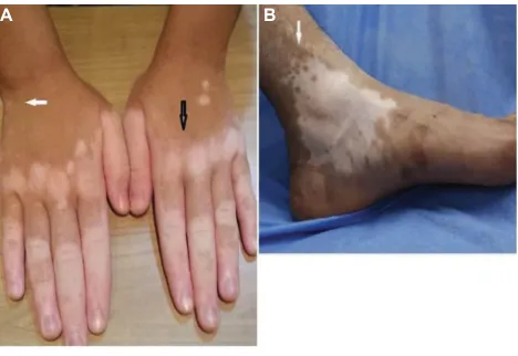 Figure 1 Clinical signs of disease activity.Notes: (A) Active disease is characterized by ill-defined borders and hypopigmented lesions (black arrow)