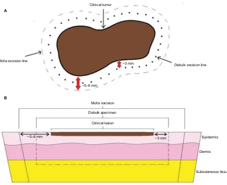 Figure 1 Schematic of Mohs micrographic surgical excision for melanoma. (A) Clinical view (B) Cross-sectional view.