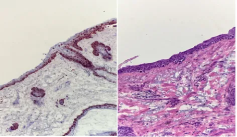 Figure 3 Photomicrographs of positive margins on MART-1 immunostain (left) versus H&e-stained (right) frozen sections displaying how MART-1 improves interpretability of MMS frozen sections for melanoma.