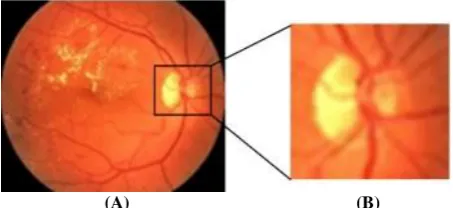Fig 1: (A) Typical image (B) Optic disc close-up view 