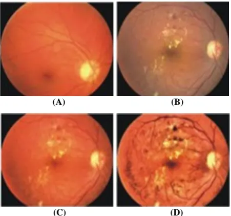 Fig. 3. (A) and (B) Example of poor quality retinal images 