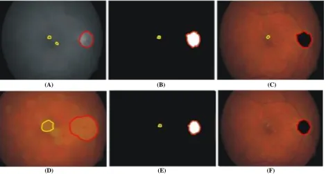 Fig. 6. (A) Intensity image after gray-scale image (B) thresholded image (C) maker image (D) reconstructed image          Furthermore, the blood vessels enter the optic disc from  (E) thresholded result of difference image (F) OD area localized The output image BW replaces all pixels in the input image 