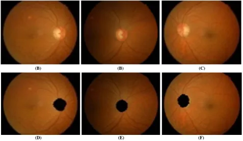Fig. 8. The effect of rotation on one sample retinal image (A), (B) and (C) a typical retinal image (D), (E) and (F) optic  disc area localized version of (A), (B) and (C), respectively    