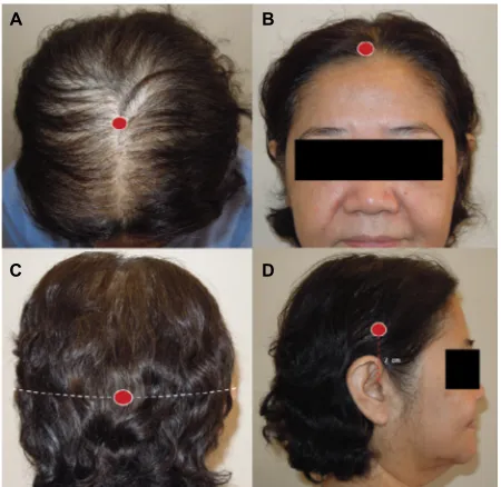 Figure 1 Measurement points (red dots) at midscalp (A), frontal area (B), occipital area (C), and parietal area (D).