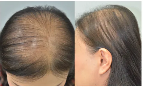 Figure 3 The clinical presentation of FPHL reveals distinctive hair thinning mostly confined to the midscalp and parietal areas.Note: The frontal hair line is usually spared.Abbreviation: FPHL, female pattern hair loss.