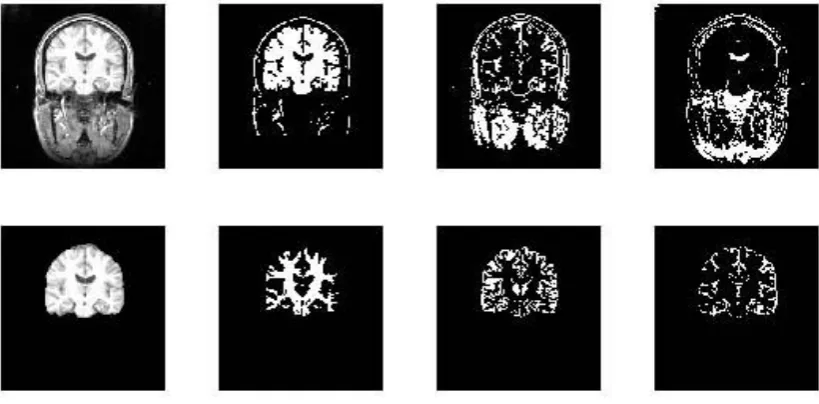 Fig. 4.  extracted brain in row 1 and row2. The three ROIs, WM, GM and CSF of head and brain obtained by FCM are in column 2-4 Segmentation results on raw and extracted brain image