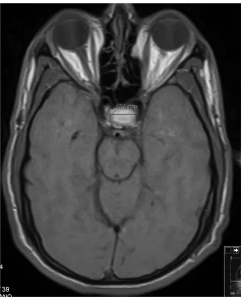 Figure 3 Axial postcontrast T1-weighted MRI through the