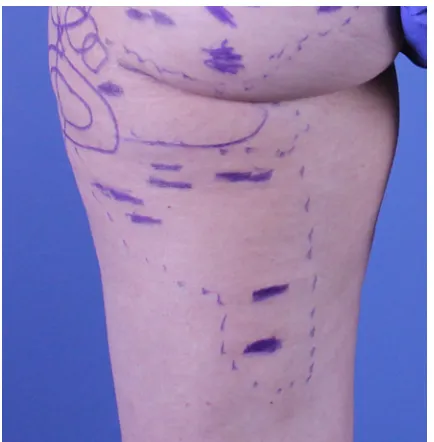 Figure 2 Significant improvement in a right anterolateral thigh cellulite depression before (A) and 30 days after (B) manual subcision.Source: Photo courtesy of Doris Hexsel, MD.